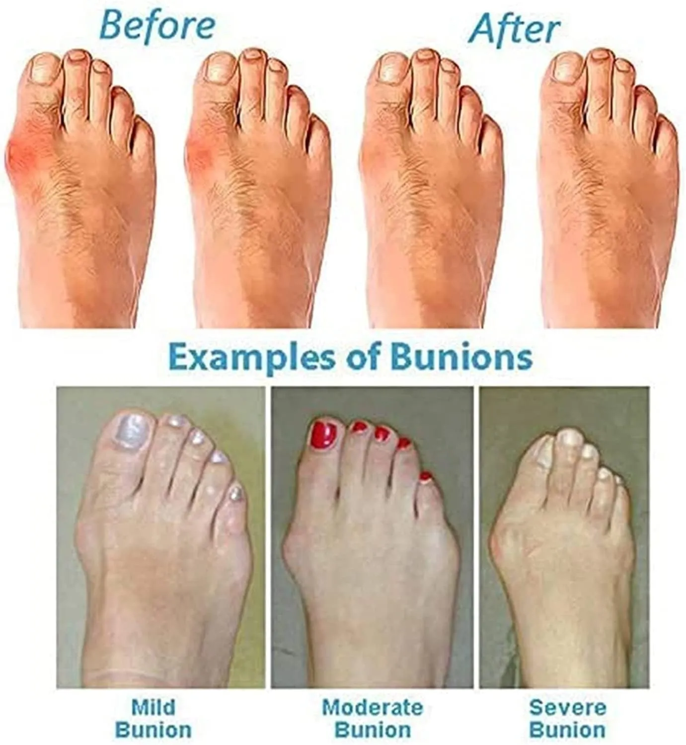 Comfortable Leather Bunion Corrector Sandals Men, Durable Men's Sandals Bunion Relief(Blue,7)